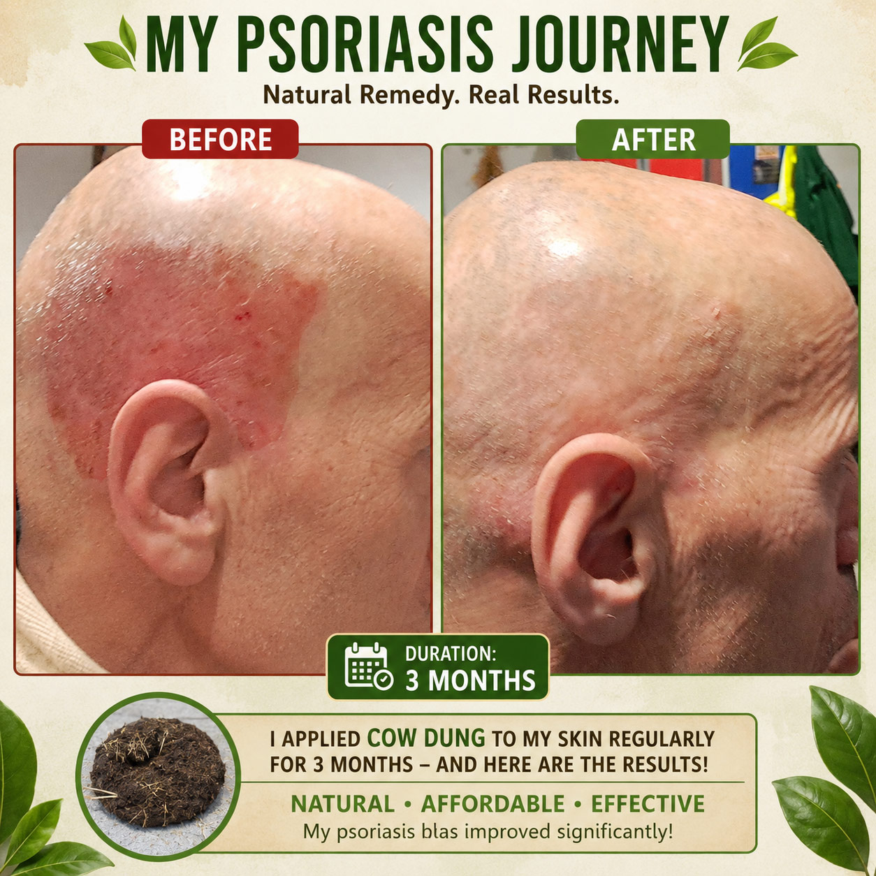 Before and after photos showing psoriasis healing after 3 months of regular cow dung application
