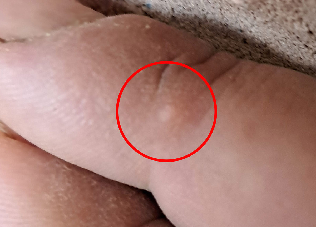 Close-up of finger showing wart that nearly disappeared after cow dung application